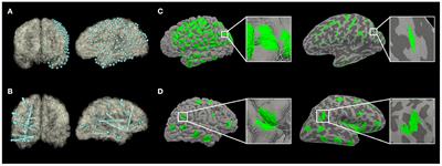 Gray Matter Sampling Differences Between Subdural Electrodes and Stereoelectroencephalography Electrodes